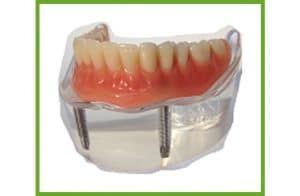 Implant Dentures — Dentures in Yandina, Queensland