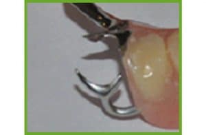Reattach Tooth Wire — Dentures in Yandina, Queensland