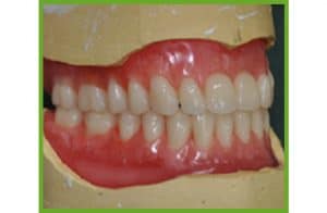 Denture — Dentures in Yandina, Queensland
